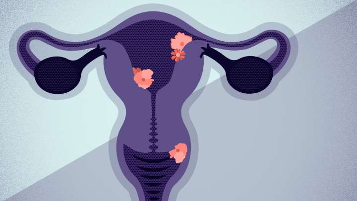 An illustration in blues and purples of the vagina and ovaries.