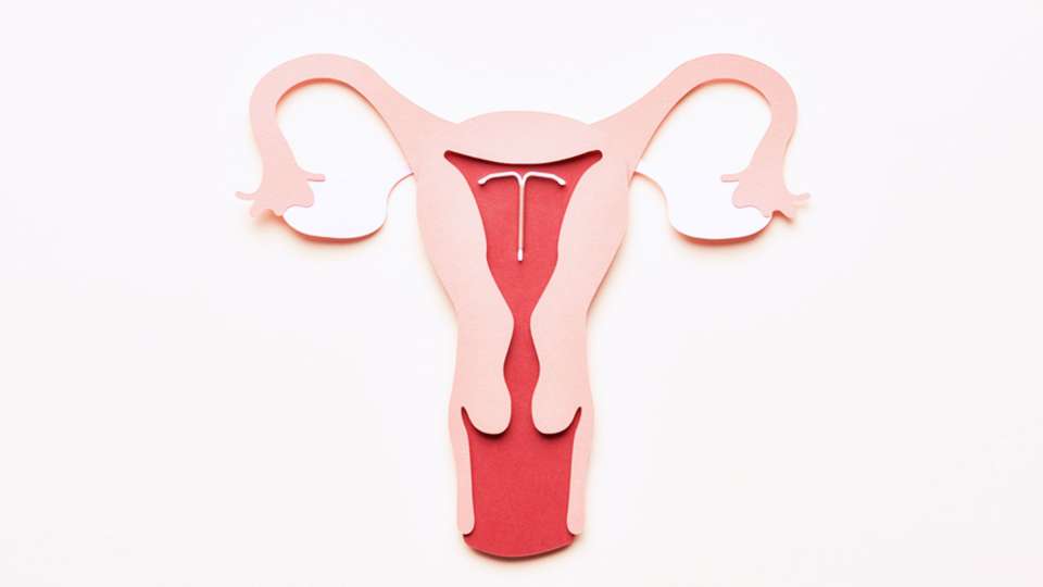 graphic of IUD placed in the uterus