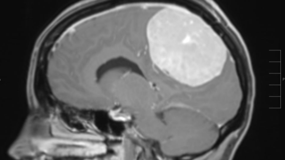 A brain scan of a large meningioma