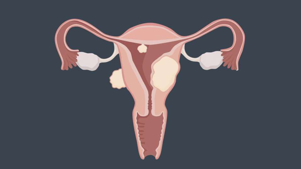 An illustration of different types of uterine fibroids.