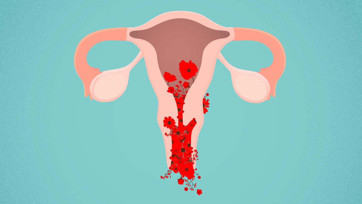 Understand and buy ovarian cancer spotting between periods O