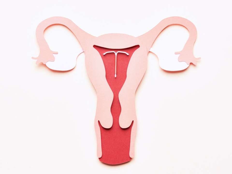 graphic of IUD placed in the uterus