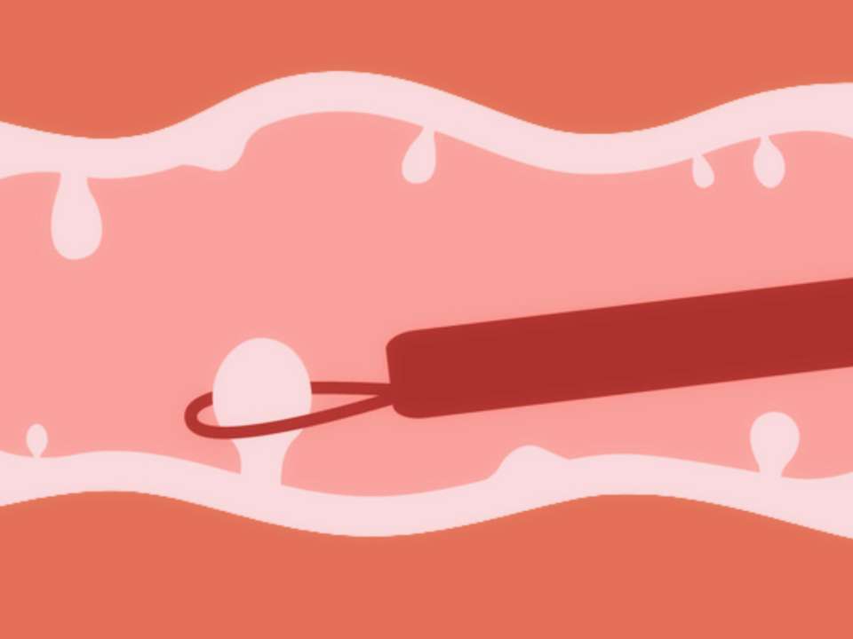 Illustration of removing a polyp