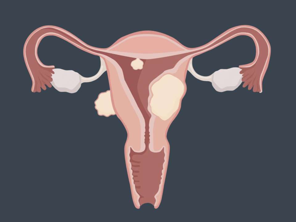 An illustration of different types of uterine fibroids.